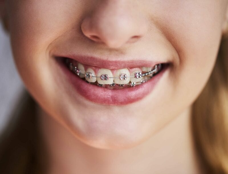 Upclose photo of teen with braces